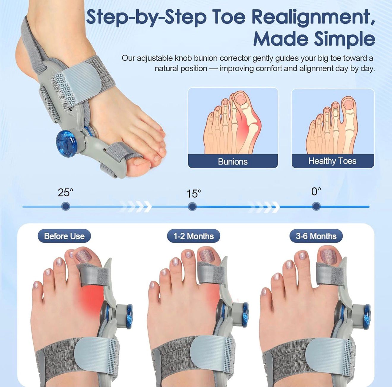 Adjustable Bunion Corrector – Comfortable Hallux Valgus Support